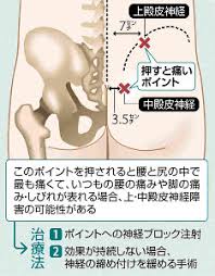 腰痛の1割は上・中殿皮神経の絞扼の可能性があると
